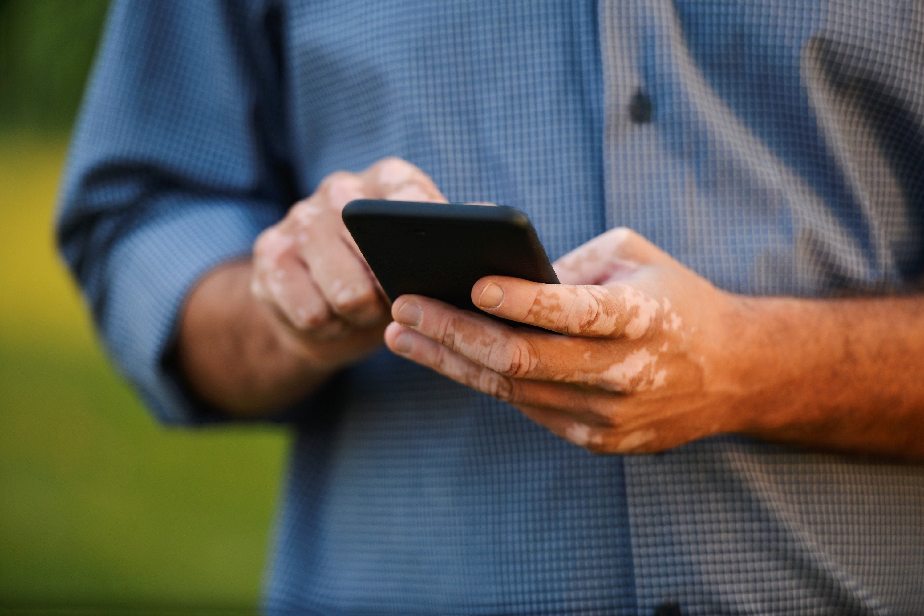 Quais as melhores opções de tratamento para vitiligo? Descubra aqui!