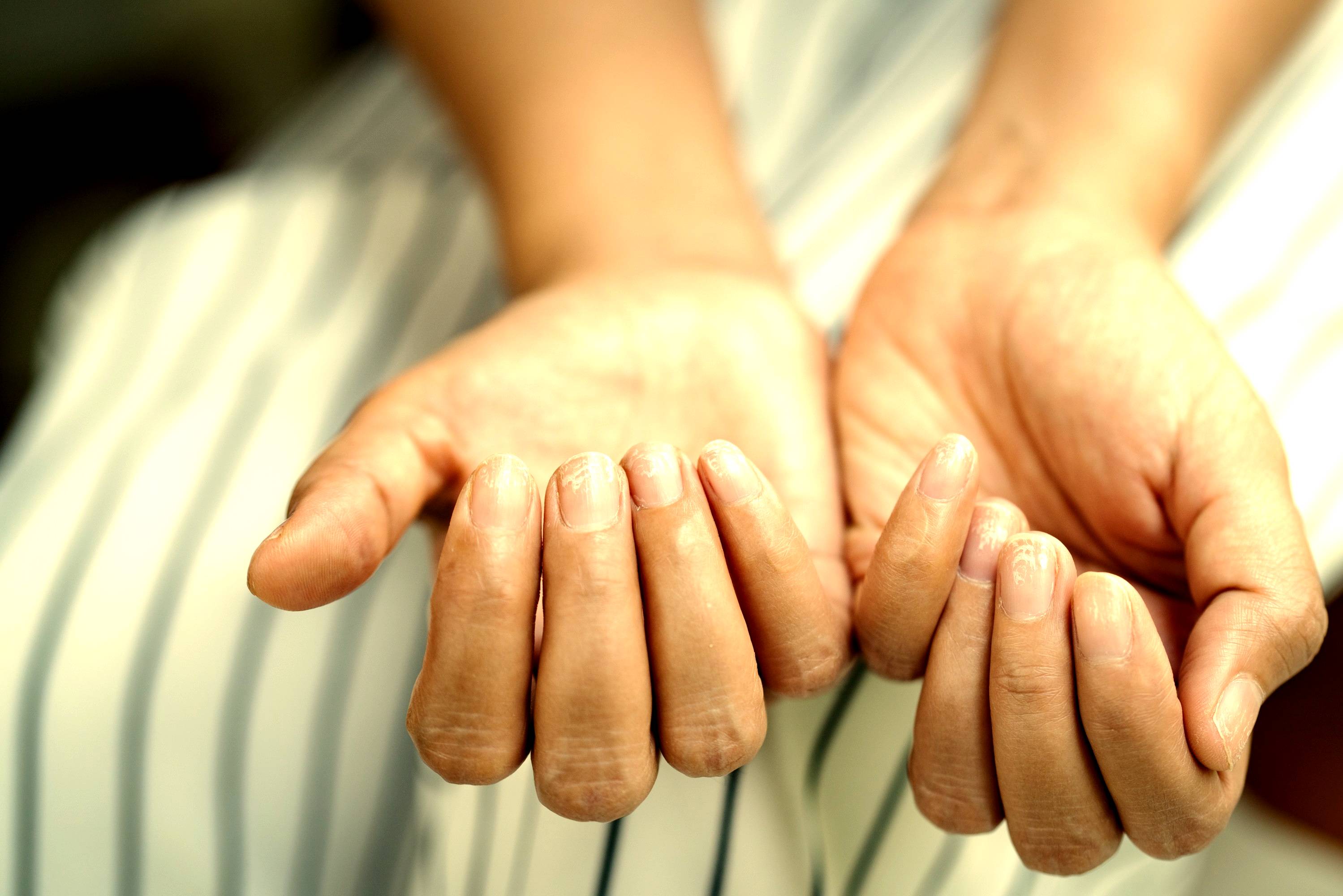 Unhas amareladas: saiba as principais causas e como tratar