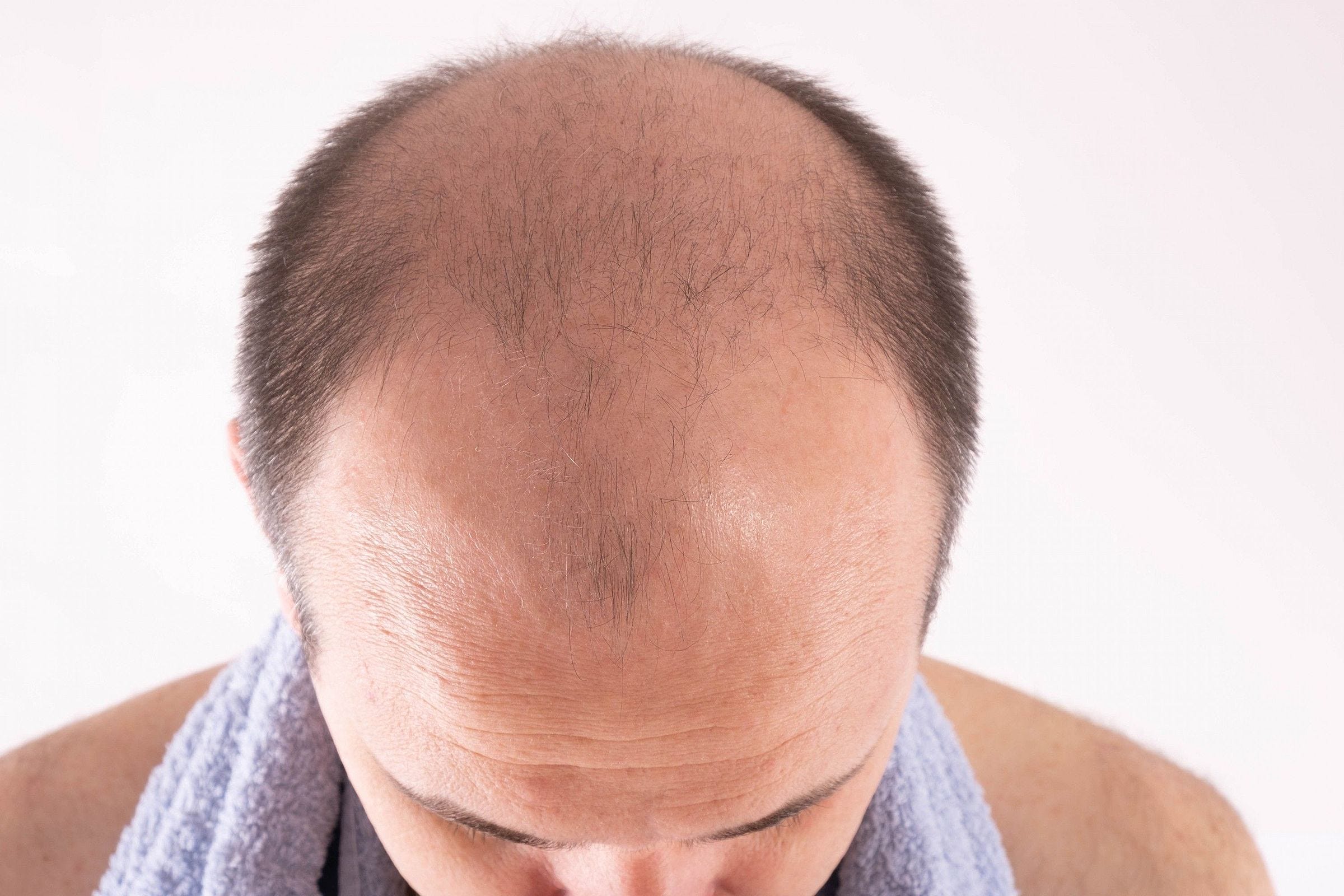 Minoxidil Turbinado: entenda para que serve e como usar!